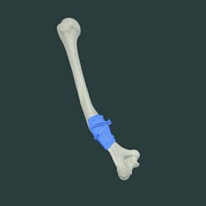 HUMERAL  OSTEOTOMY