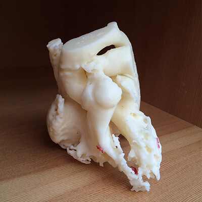 3D model of ventricular septal defect