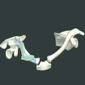 Clavicle Correction Clavicle Correction