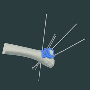 DISTAL Tibia Osteotomy 