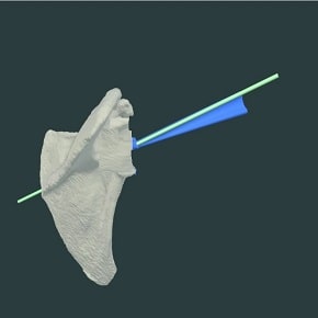 Humeral cutting guide Humeral cutting guide
