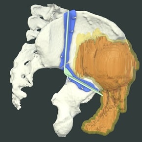 Ilium Resection