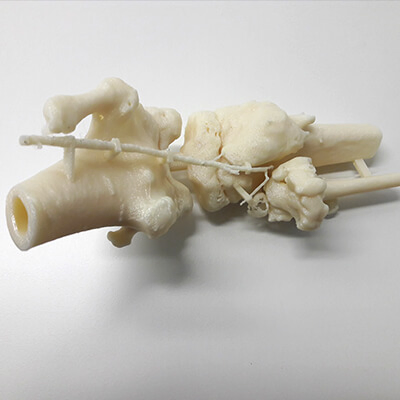 Model of a knee with multiple exostoses