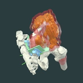 Sacral Cutting Sacral Cutting