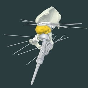 Acetabulum Resection