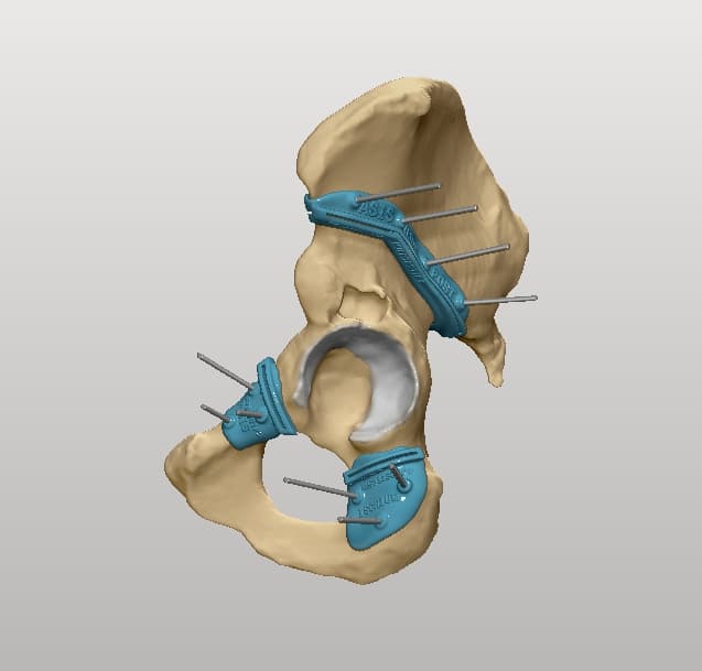 Digital planning for hip surgery