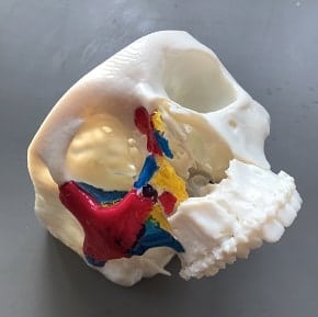 3D skull model for orbital floor reconstruction
