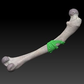 Virtual reality model of femur and surgical guide