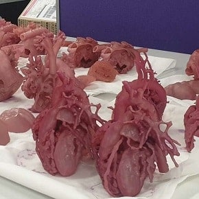 3D congenital heart defect models