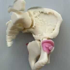 Surgical cutting guides for Ewing sarcoma