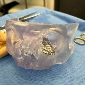 Orbital floor implant model in theatre