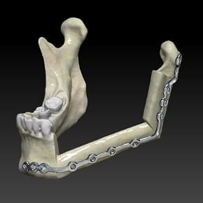 Virtual reality model for a mandible implant
