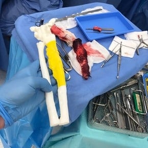 Surgeon holds a radial sarcoma model in theatre