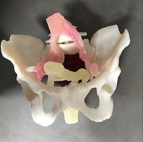 3D model of an ependymoma