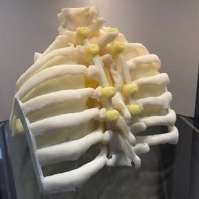 Model of a spinal chordoma
