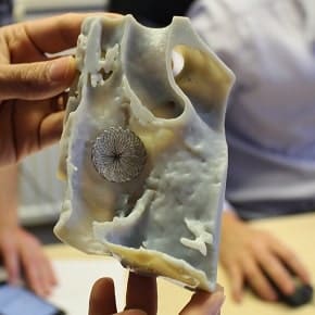 Cardiologist assesses stent size using 3D heart model