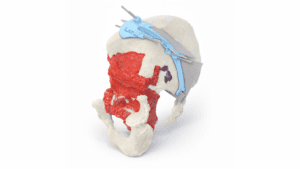 Advanced Chondrosarcoma Resection Technique.