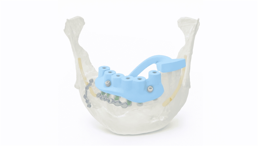 Dental implant positioning guide for fibula free flap reconstruction.