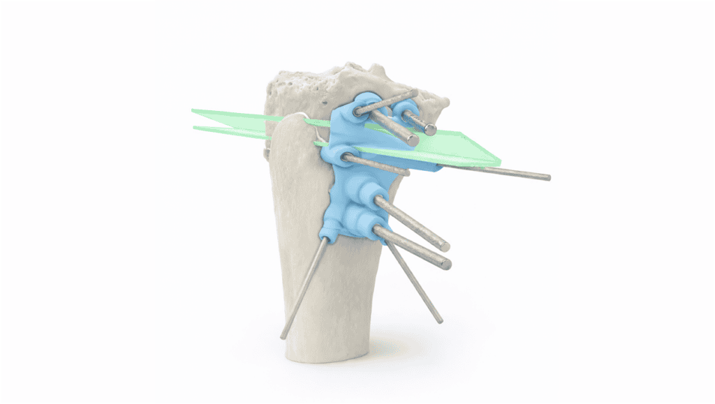 Minimally invasive high tibial osteotomy procedure for knee realignment and pain relief.